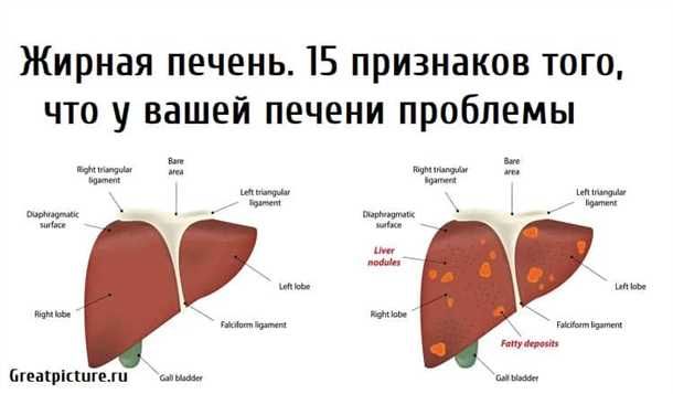 Предупреждение болезней печени
