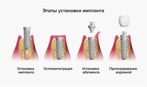Преимущества имплантации перед съемными протезами
