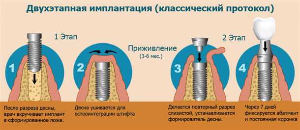 Популярные ошибки пациентов при подготовке к имплантации