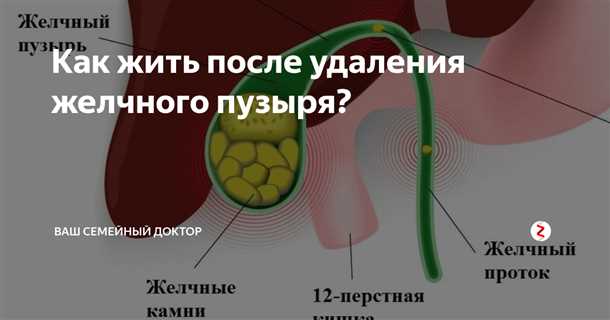 Лапароскопическая холецистэктомия
