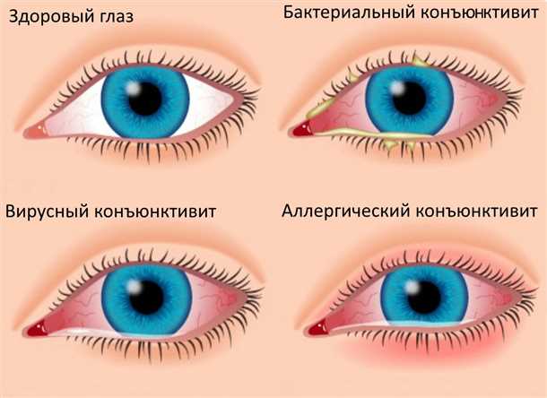 Что такое компьютерный синдром?
