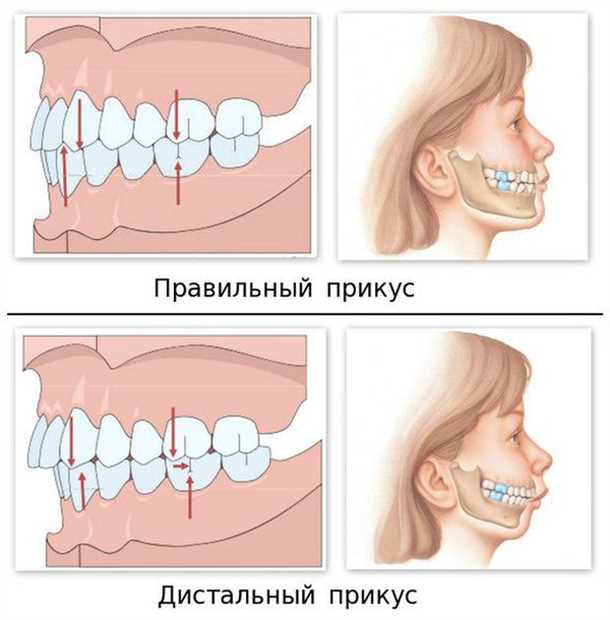 Последствия нелеченого дистального прикуса