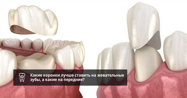 Выбираем коронку: факторы и рекомендации