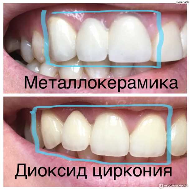 Коронки из циркония: надежность и эстетика