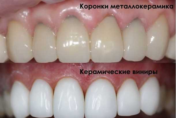 Металлокерамические коронки: свойства и применение