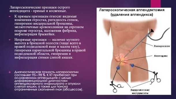 Какие ощущения являются симптомами аппендицита?
