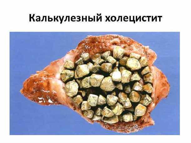 Холангит