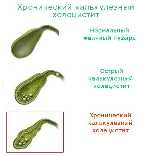 Холестериновые камни