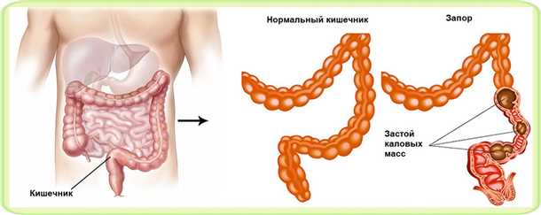 Как предотвратить каловую интоксикацию