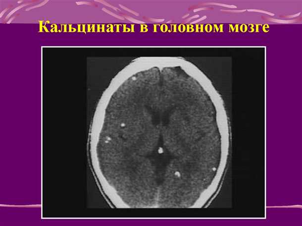 Причины образования оксалатов кальция