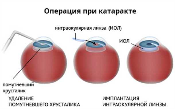 Что такое катаракта - глазное заболевание
