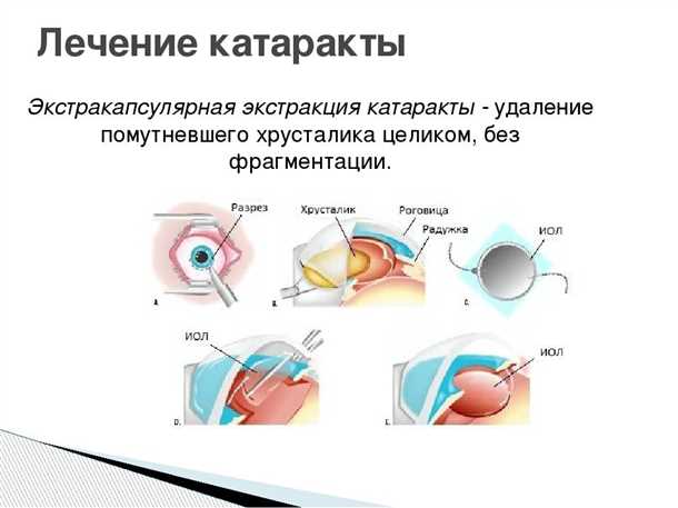 Хирургическое удаление катаракты
