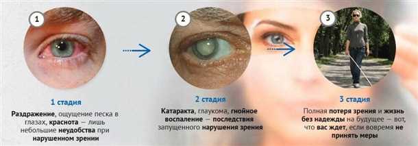 Катаракта при сахарном диабете – важная проблема