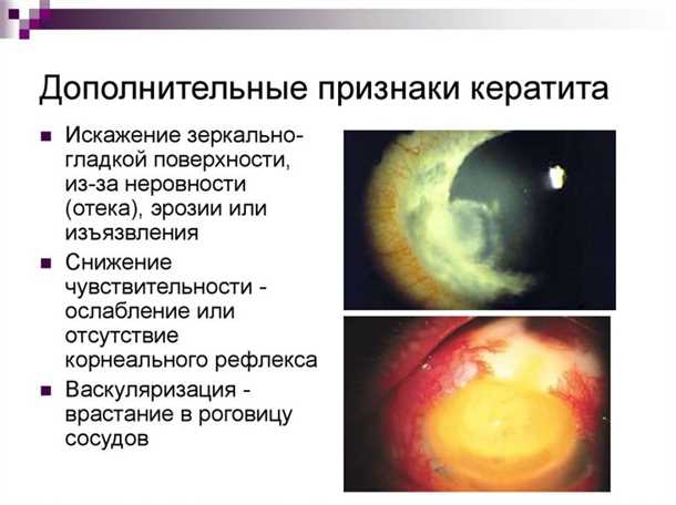 Дополнительные симптомы кератита: