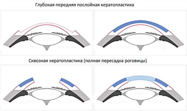 Преимущества и риски кератопластики