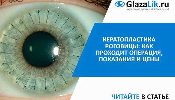 3. Пенетрирующая кератопластика