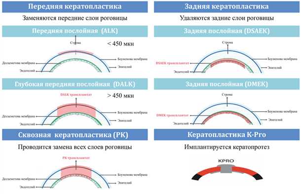 Кератопластика, что такое кератопластика, фото, цены, отзывы.
