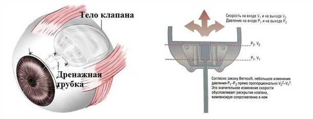 Глазные болезни: как работает клапан?