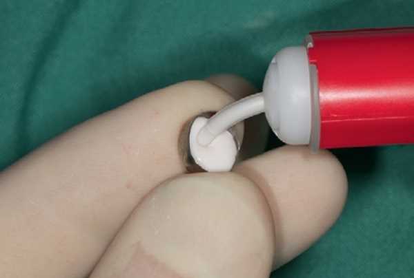 Побочные эффекты при использовании клея для фиксации зубных коронок