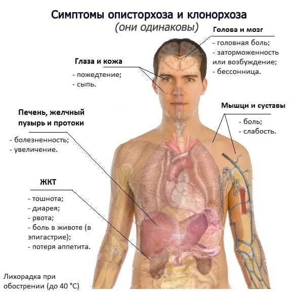 Клонорхоз