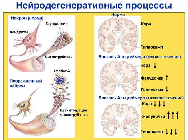 Влияние нейродегенеративных заболеваний на судорожную готовность