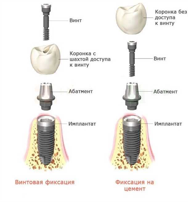 Стоимость коронки на имплант