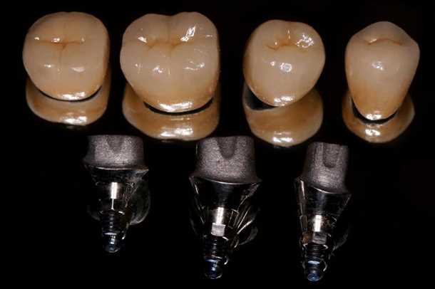 Какие патологии лечатся с помощью коронки на имплант?