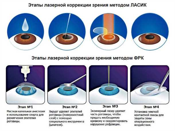 Сравнение методов коррекции зрения