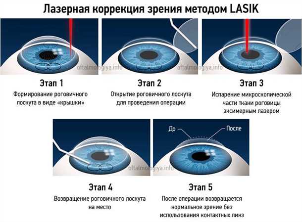 3. Лазерная коррекция зрения