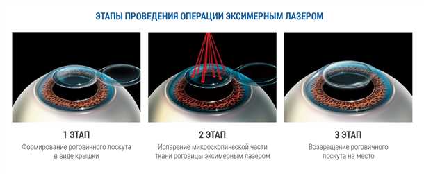 Имплантация факической линзы