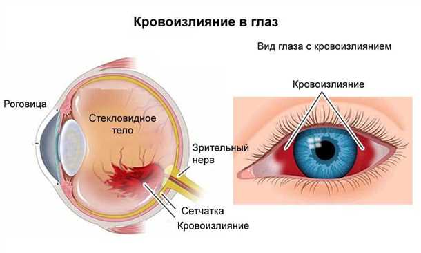 Кровоизлияние в глазе: последствия и осложнения