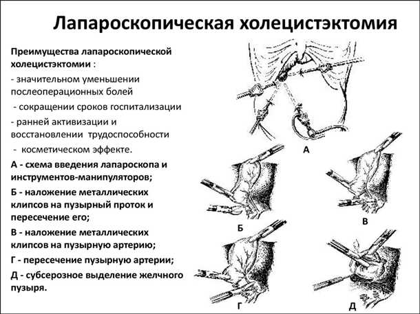 Преимущества лапароскопической холецистэктомии перед открытой операцией