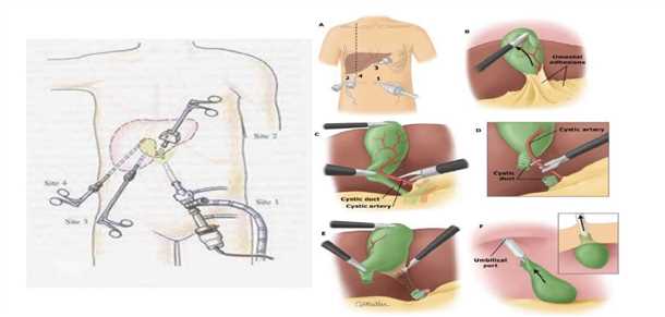 Что такое лапароскопическая холецистэктомия?