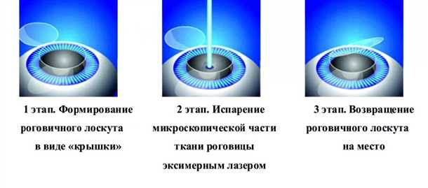 ЛАСИК