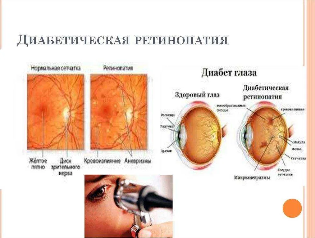 Лазерная фотокоагуляция глаза: спасение от диабетической ретинопатии