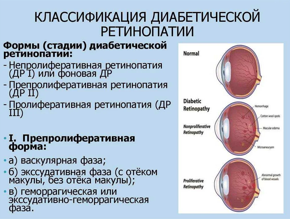 Процесс лазерной фотокоагуляции глаза
