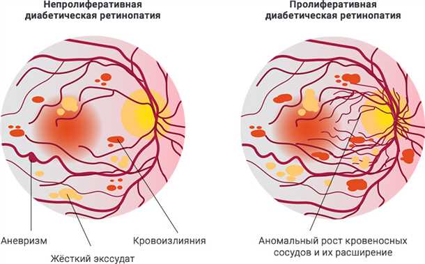 Лечение диабетической ретинопатии — как пациенту с диабетом спасти своё зрение?