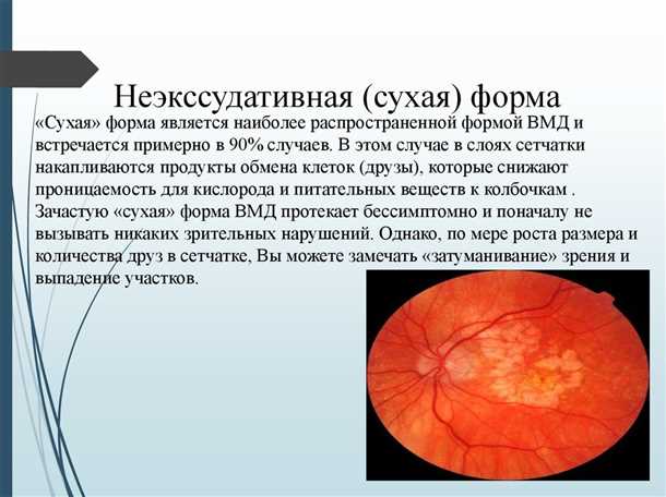 Лечение сухой формы ВМД: общие принципы