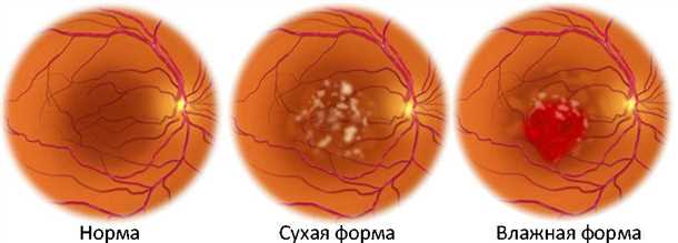Физиотерапия и хирургические методы лечения сухой формы ВМД