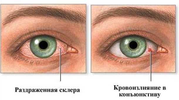 Симптомы разрыва сосуда в глазу