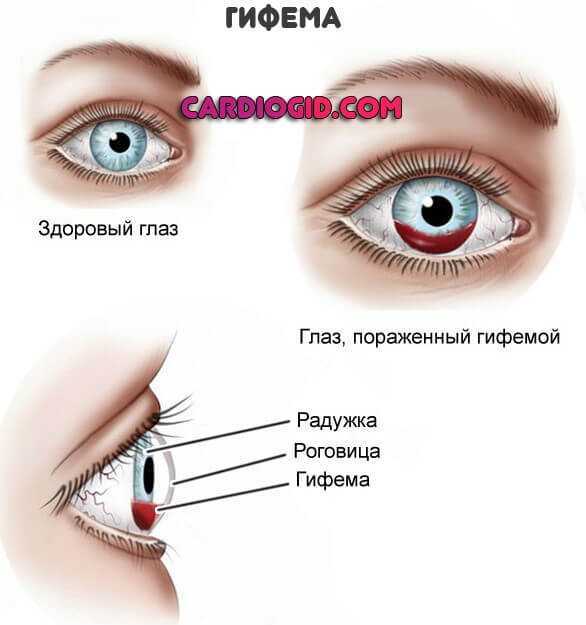 Лечение разрыва сосуда в глазу