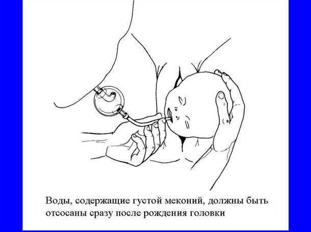 Лечение мекониемии