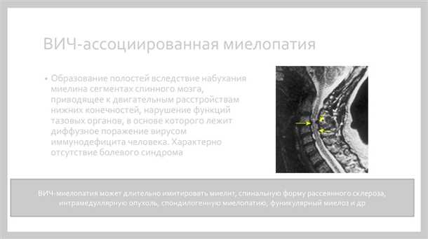 Миелопатия.