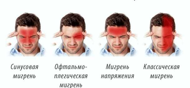 Главные признаки острой головной боли и сопутствующие симптомы