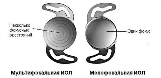 Как выбрать мультифокальные ИОЛ