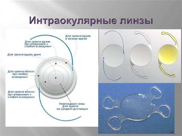 Кто нуждается в мультифокальных торических интраокулярных линзах?