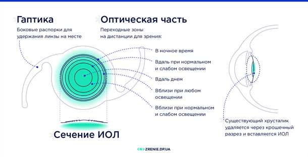 Преимущества мультифокальных торических интраокулярных линз: