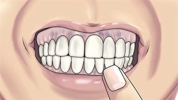 2. Пародонтит