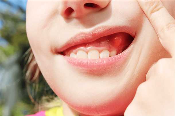 На десне надулся шарик что делать На десне надулся шарик что делать