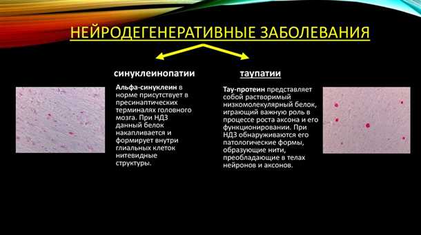 Расстройства моторики при болезни Хантингтона
